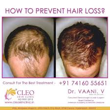 Its complete waste of money and time,better visit some dermatologist. V Care Hair Treatment For Baldness Haireca