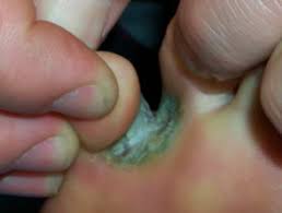 Fungus treatment between the toes is held under the supervision of a physician. Tinea Pedis Dermnet Nz