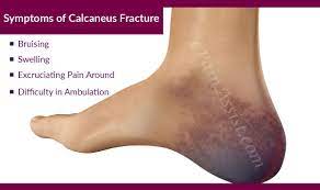 Symptoms Of Calcaneus Fracture Or Broken Heel Calcaneus Fracture Treatment Recovery Heel Treatment