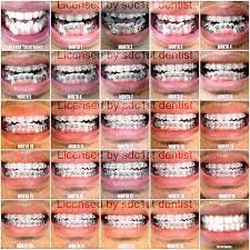 Amazing Effect Of Braces Teeth After Braces Braces Tips Dental Braces