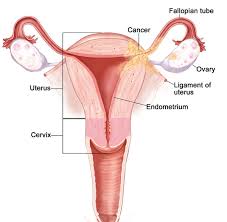 Rahim kanseri, uterus kanseri olarak da bilinir. Endometrium Rahim Kanseri Tedavisi