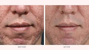Microdermabrasion vs. Microneedling: Cost, Results & Methods