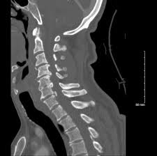 Image result for Spinal Shock