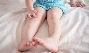 Muckenstiche Behandeln Tipps Fur Eltern Muckenstiche Behandeln Muckenstich Kratze