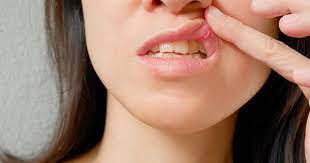 Trung quốc thông báo, số ca nhiễm virus corona không bộc lộ triệu chứng ở nước này tăng cao nhất trong 7 tháng qua. Tá»•n ThÆ°Æ¡ng Miá»‡ng Long Ban Tay Triá»‡u Chá»©ng Má»›i Cá»§a Covid 19