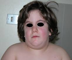 Prader Willi Syndrome