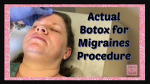 After your first treatment, it can take around 10 to 14 days to start seeing the results of botox for migraine headaches. Actual Procedure Botox Injections For Migraines Youtube