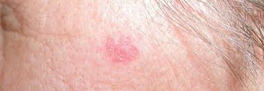 Salbe Lasst Oberflachliche Basaliome Verschwinden Immunmodulator Wirkt Auch Bei Weissem Hautkrebs Medical Tribune