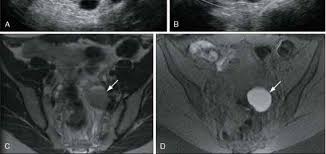 The results in 4350 patients confirmed that ultrasound examination, both transabdominal and transvaginal, can be considered quite satisfactory because the sensibility was 100%. Detection And Characterization Of Ovarian Tumors Role Of Ultrasound Ovarian Cancer