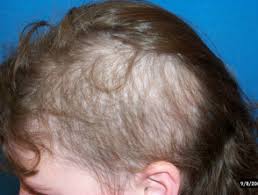 You do not need to worry in case the baby has thin are the bald parts where the skull plates (rather, the seams) are, in which case it could be growth causing it? Hair Loss Dermnet Nz