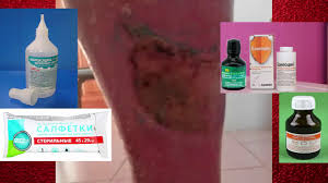 Techet Limfa Iz Nogi Kak Lechit Rasskazyvayu Youtube