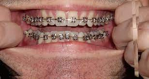 Braces Photo Taken Every Day Before And After Transformation Ortho Hey Snaggle Tooth Dental Braces Expanders For Teeth Orthodontics