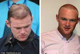 Ich drohte, mit 25 kahl zu werden. Wayne Rooney Hair Transplant Before After Procedure Men S Hairstyles Club Hair Transplant Wayne Rooney Hair Transplant Cool Boys Haircuts