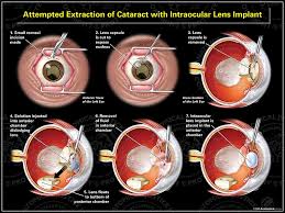 Image result for Cataract Extraction