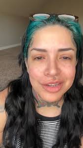 #badskin #acne #histamineintolerance #skincare