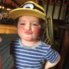 Mum claims three-year-old son is treated like modern-day leper with plague  by people in street because of ECZEMA