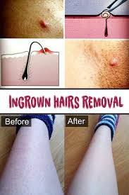 Ingrown Hairs Removal Ingrownhairbikini Ingrown Hair Ingrown Hair Removal Hair Removal
