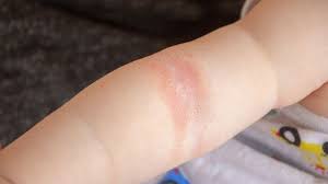 But depending on its underlying cause. What S That Rash With Pictures Queensland Health