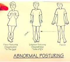 Posturing Nurse Nursing Mnemonics Nclex