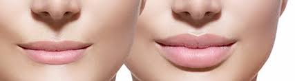 And propane is the right energy source for everything from home heating and cooking, to powering farms, forklifts, mowers, and more. Best Lip Injections Treatment All About You Medical Spa