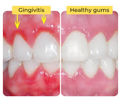 A few bad habits can lead to gum disease, which can have some serious repercussions for your overall health. Share Dental Care Home Facebook