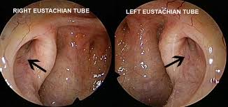 Image result for Eustachian Tube Dysfunction