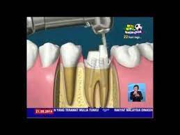 Gigi akan dibur untuk menghilangkan jaringan karies/nekrotik sampai dengan kamar kamar pulpa dan. Rawatan Matikan Akar Gigi Root Canal Treatment Di Klinik Presint 18 Rrai