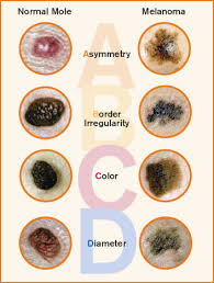 According to the american cancer society, just over 100,000 new cases of skin cancer are diagnosed in the united states each year. May Is National Skin Cancer And Melanoma Awareness Month Renaissance School Of Medicine At Stony Brook University
