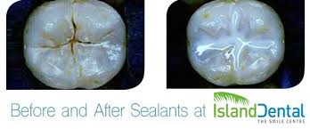To seal the pits and fissures from bacteria and prevent what do you use to clean the grooves before you place a sealant? Fissure Sealants Island Dental