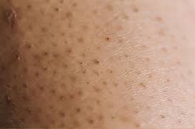 Laser hair removal could be the solution to anyone who is simply tired of dealing with ingrown hairs. Laser Hair Removal For Ingrown Hairs Dermacore Telford Shropshire