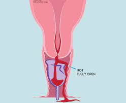 Why Is My Menstrua Cup Leaking Easy Fixes To Avoid Future Leaks A second or third day heavy is okay. why is my menstrua cup leaking easy