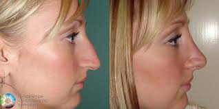So i love the appearance of my nose from the front and i don't have a big nose but i do have a bump to it from the side. Rhinoplasty Before And After Photo Gallery Denver Golden Co The Center For Cosmetic Surgery