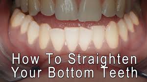 We did not find results for: Dental Braces How To Straighten Your Bottom Front Teeth Youtube