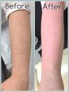 Before And After Bleach Body Hair
