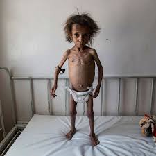 E·ma·ci·at·ed , e·ma·ci·at·ing , e·ma·ci·ates to make or. Kalinka It Is Impossible To Believe That This Emaciated Facebook