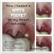 How I Healed A White Pocket On My Throat Naturally Sore Throat Remedies For Adults Throat Remedies Tonsilitis Remedy
