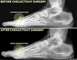 Learn What A Cheilectomy Surgery Is Arthritis In Big Toe Bone Spurs Sore Feet Remedies