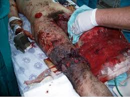 In most cases, this mod will lower average damage. Pdf Wound Ballistics And Tissue Damage Nimrod Rozen And Israel Semantic Scholar