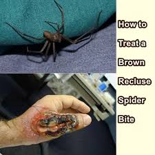 They have a toxin capable of a systemic reaction that affects muscle and nerve function.﻿﻿ black widow spider bite symptoms can be used to. How To Treat A Brown Recluse Spider Bite The Homestead Survival
