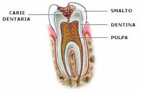 Image result for Pulpitis