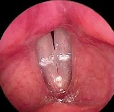 Image result for Reflux Laryngitis