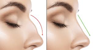 When most people think of nose surgery, they are thinking of rhinoplasty, which is a surgical procedure that can improve the appearance of the nose. Q A For Rhinoplasty Revision North Shore Aesthetics