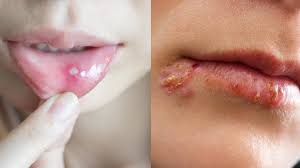 Diferenças entre afta e herpes labial (com imagens)