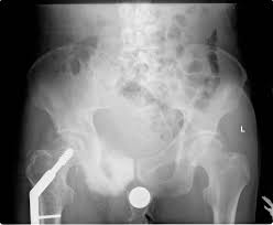 The symptoms of bone cancer are: Pelvic Osteosarcoma Radiology Case Radiopaedia Org