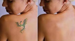 Things that tattoo studio specialists must inform the clients about Laser Tattoo Removal Aftercare Instructions Lovetoknow