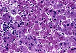 العلماء يرجحون انتال كورونا من الخفافيش إلى الإنسان. Ù…Ù„Ù Marburg Virus Liver Injury Jpg ÙˆÙŠÙƒÙŠØ¨ÙŠØ¯ÙŠØ§