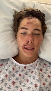 TikTok star Caleb Coffee breaks silence after falling onto lava rocks