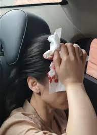 突发黄圣依拍戏时被砸伤现场图曝光鲜血直流被紧急送