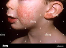 Image result for Papular Acrodermatitis