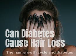 Proper exercise can help improve your blood circulation and counteract poor blood circulation related from diabetes. Hair Loss Due To Diabetes Diabeteswalls